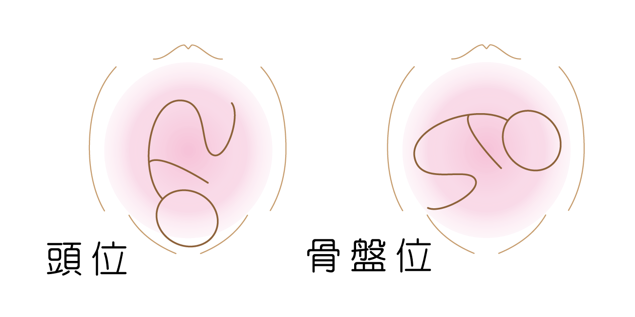 逆子:骨盤位