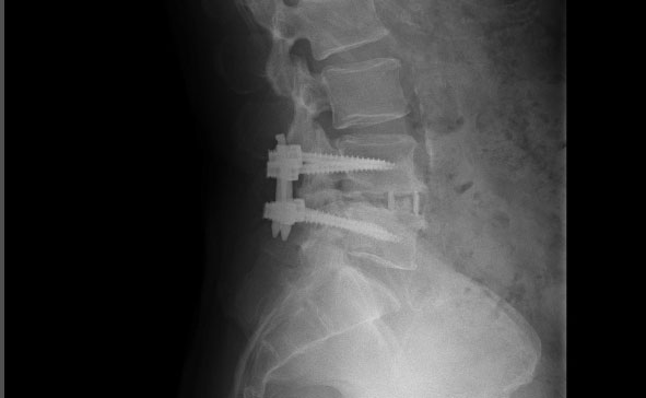 脊柱菅狭窄症の手術