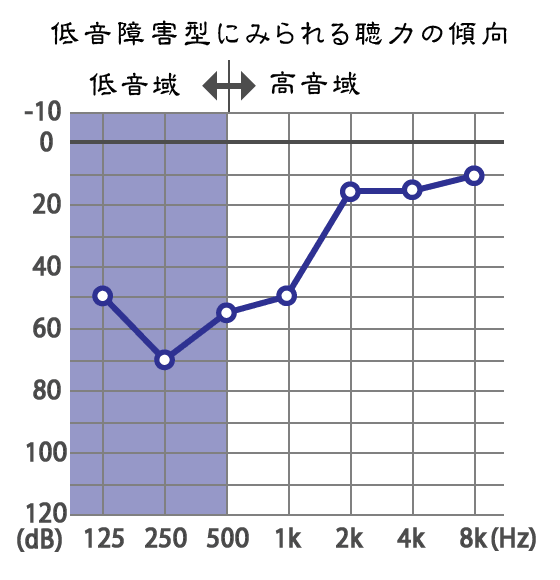 メニエール病:難聴の聴力低音障害型