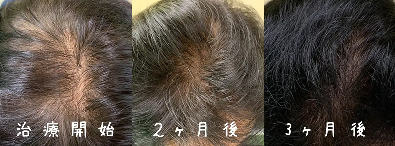 薄毛に対する鍼灸治療