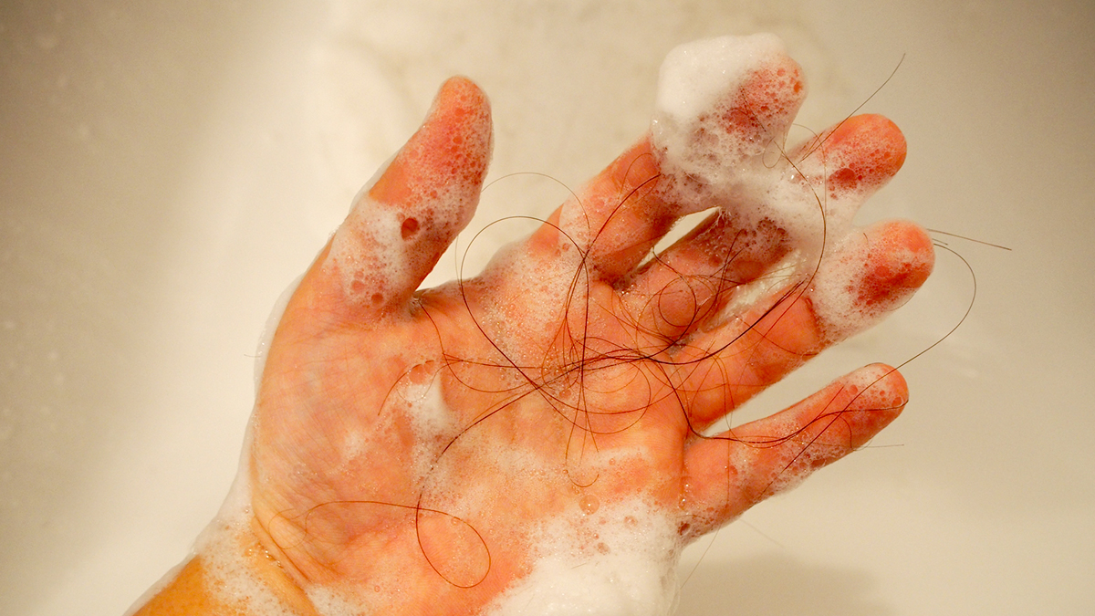 中野区女性薄毛外来