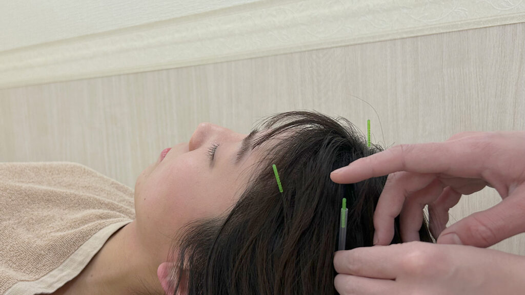 中野区女性の抜け毛クリニック