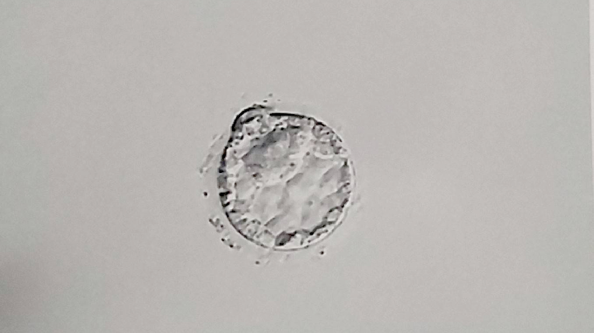 中野区体外受精と不妊症