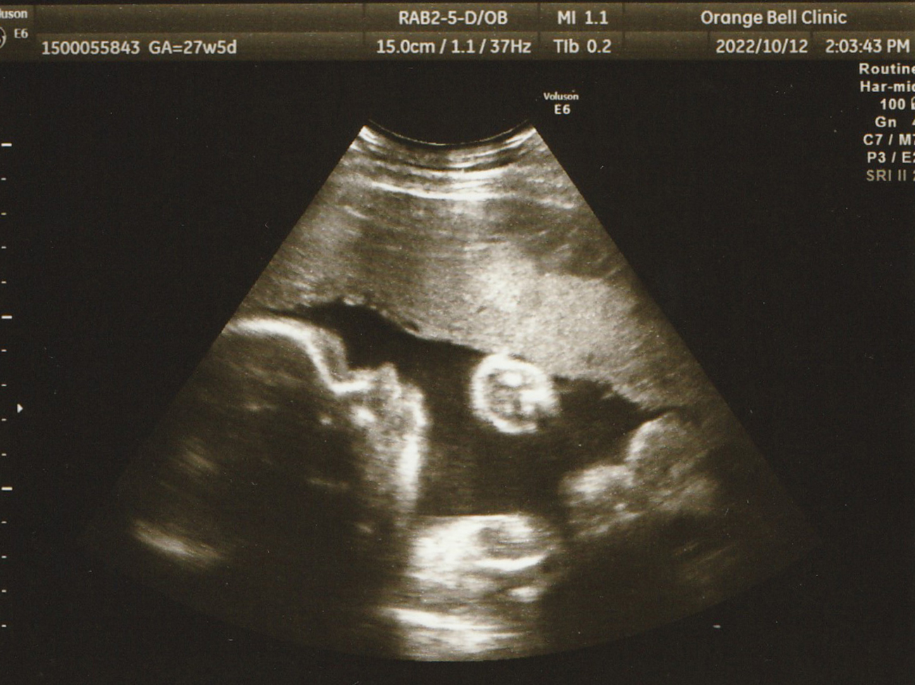 逆子体操で治らなかった時はどうすればいいの？