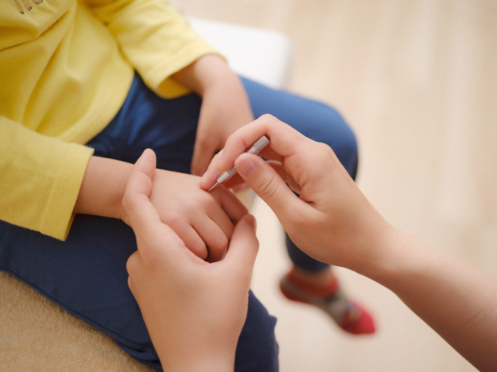 子供の脱毛症治療